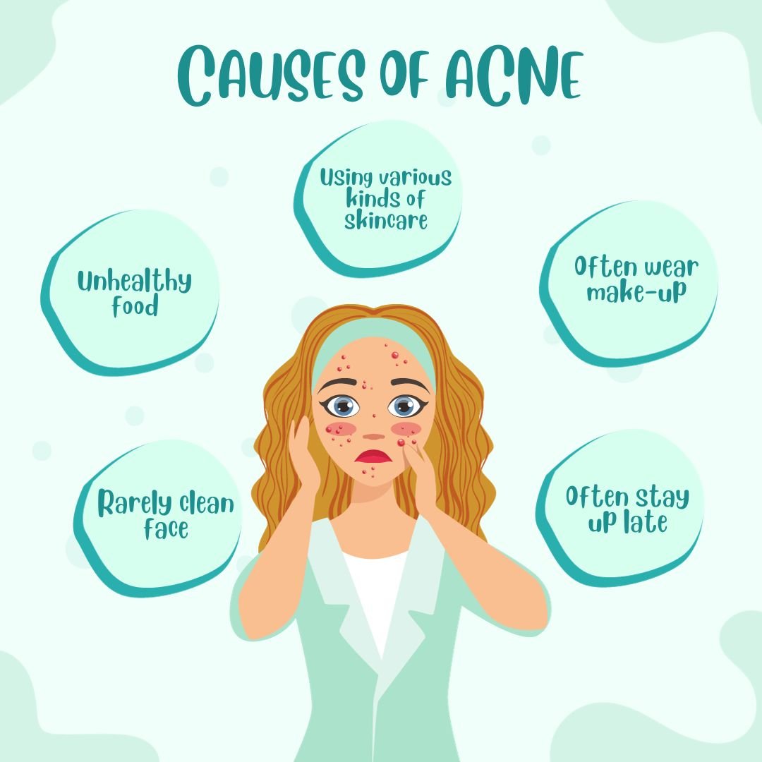 PCOS Acne Blog Image - Understanding the Causes of Acne with expert insights from Dr. Shabnam Sharjil at PCOS Ferticure Clinic.